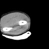 SPORK, NICO - 22.03.1976 - 02.08.2022 - CT obere Extremität - 17:56:57